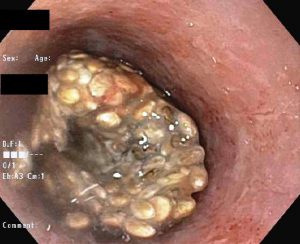 Chia seed impaction in esophagus