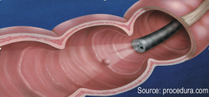 ScopeandPolyp